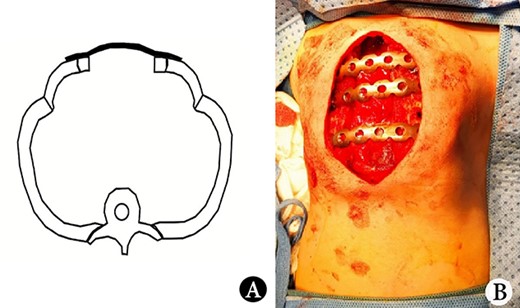 (A) Schematic diagram of operation, and (B) operative picture.