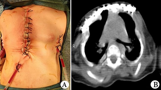 (A) Thorax appearance after operation, and (B) CT scan image of thorax after operation.