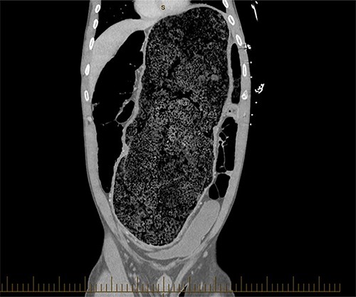 Coronal view of a CT image of a large faecaloma in the sigmoid.