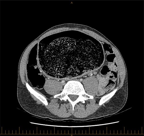 Axial view of CT image of abdomen.