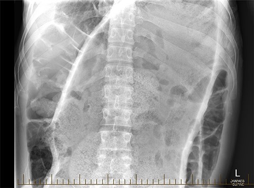Plain film radiograph of the abdomen.