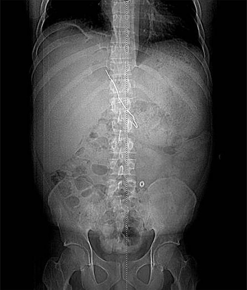 CT scout view of metallic foreign body.