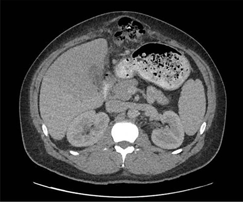 CT view of metallic foreign body within the transverse colon.