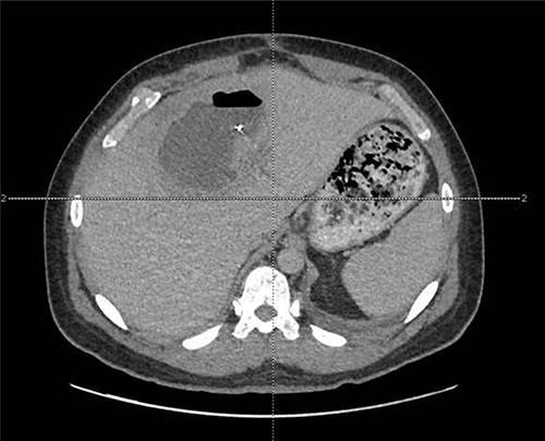 CT view of metallic foreign body within the liver abscess cavity.