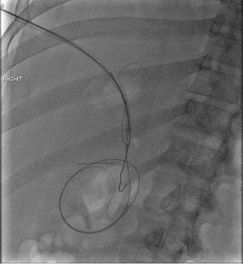 Fluoroscopic image obtained intraoperatively demonstrating removal of the metallic foreign body