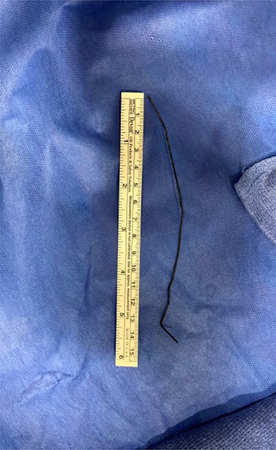 Metallic foreign body removed from liver abscess.