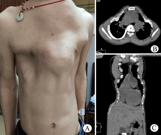 (A) Thorax appearance before operation; and (B) and (C) CT scan of thorax.
