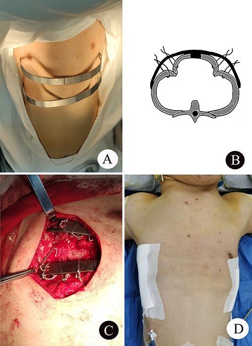 (A) The shape of the two steel bars and the approximate position; (B) schematic diagram of operation; (C) the operation picture; and (D) thorax appearance after operation.