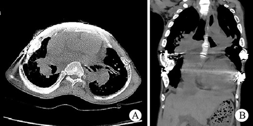 (A) and (B) Postoperative CT scan of thorax.
