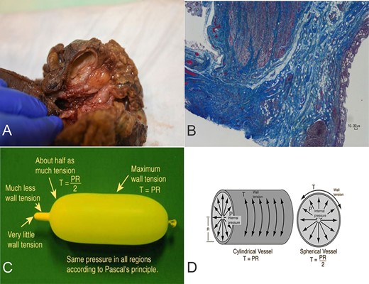 (A) Diverticulum at the junction of terminal ileum (right) and cecum (left). (B) Ileocecal muscle (left) and diverticulum with flattened colonic mucosa (right). Masson trichrome. X2 magnification. (C-D) Laplace’s Law: the pressure inside a container with curved walls is inversely proportional to its radius. Figure 1C and 1D are reproduced from "Hyperphysics" (http://hyperphysics.phy-astr.gsu.edu/hbase/ptens.html) with permission received from Dr. C. R. Nave, HyperPhysics Project, Department of Physics and Astronomy, Georgia State University, Atlanta, GA 30303, United States.
