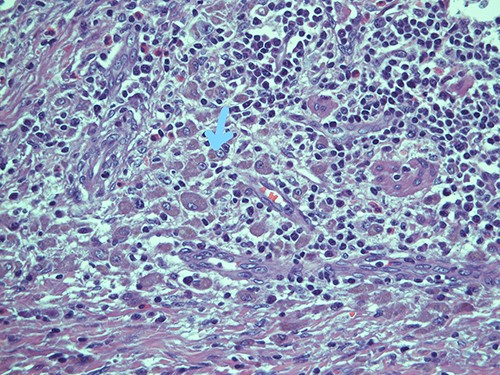 Submucosal cellular population is constituted by round histiocytic elements with a granular dense cytoplasm, containing typical eosinophilic bodies (arrow); haematoxylin and eosin, magnification ×20.