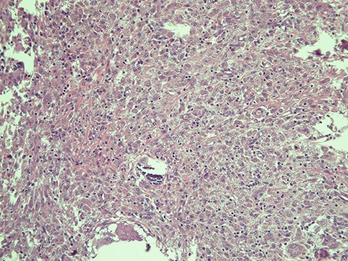 Submucosa is expanded and colonized by a dense histiocytic population (von Hansemann cells) and harboring microcalcifications; haematoxylin and eosin, magnification ×20.