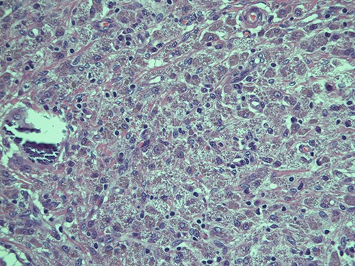 Intracellular and extracellular Michaelis–Gutmann bodies surrounded by inflammatory cell infiltrate of histiocytes; haematoxylin and eosin, magnification ×40.