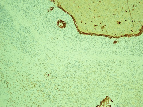 The most represented population is pancytokeratin negative, confirming its non-epitheliod and non-neoplastic nature; pancytokeratin, magnification ×10.