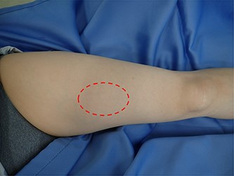 Large palpable mass in the left thigh.