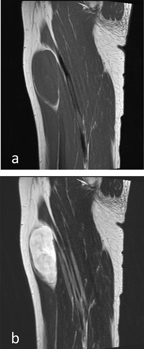 MRI imaging (sagittal section). (a) Low-signal intensity to isointense in muscles on T1-weighted images. (b) Hyperintense on T2-weighted images.