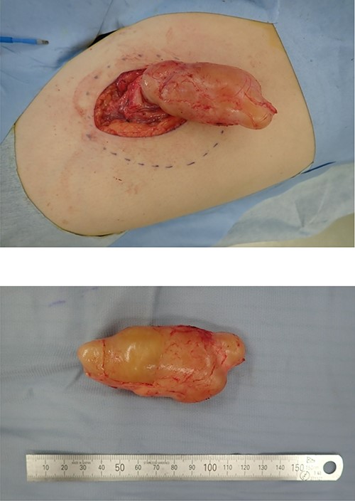 Giant encapsulated tumor after resection, ~9.0 × 3.0 cm in size. No adhesion to the adjacent tissue or vascular involvement.