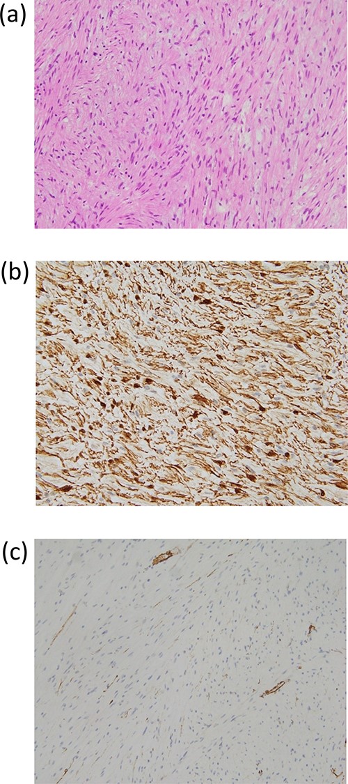 (a) Pathological findings (hematoxylin–eosin stained × 200): The tumor cells were mainly spindle cells with an abundance of rich mucus-like material in the background. Immunohistochemistry results (× 200): (b) Positive staining for S-100 protein. (c) Positive staining for CD34.