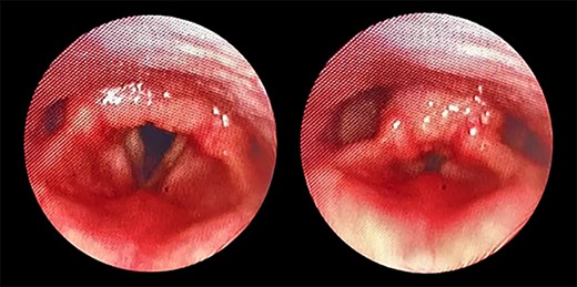 Transnasal flexible endoscope showing broad-based lesion affecting the middle two-third of the right vocal fold with a granular appearance of the interarytenoid region.