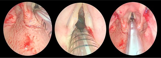 Direct laryngobronchoscopy showing a polypoidal lesion on the middle third of the left vocal fold with a granular appearance of the interarytenoid region and cobblestoning of the posterior pharyngeal wall.
