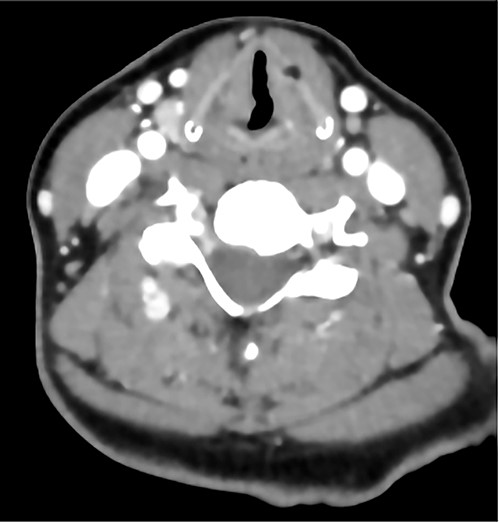 A contrasted neck CT scan showing bilateral asymmetric thickening of the vocal folds with medialization of the right vocal fold.