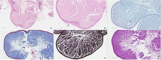 Biopsies show polypoid squamous epithelium-lined stroma containing abundant amorphous, eosinophilic acellular hyaline material (Hematoxylin and Eosin stain; a, b). This material is Alcian blue positive (c), PASD positive (d), EVG positive (e) and Trichrome (for fibrin) negative (f).