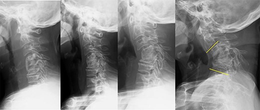 History of kyphosis after ACCF (anterior cervical corpectomy and fusion), and the patient had undergone ACCF 12 years ago for cervical spondylotic myelopathy; the kyphotic changes occurred early in the postoperative period and gradually progressed. POY1, 5, 12: Postoperative year 1, 5, 12.