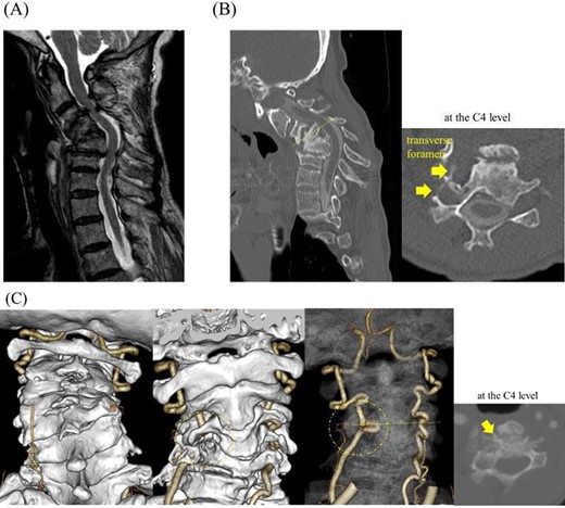 CT myelography, MRI and CT angiography on admission; (A) stenosis at the C3/4 level with C3 anterior slip was observed on magnetic resonance T2-weighted images, and (B) the C4–6 vertebrae were fused into a single mass; note local kyphosis and scoliosis due to vertebral collapse, and a transverse slice at the C4 level showed two transverse foramina on the right side, and (C) the right VA invaginating into the C4 vertebral body was shown in a transverse slice at the C4 level on CT angiography.