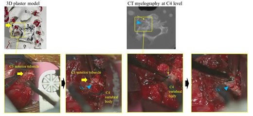 VA identification under the C3 anterior tubercle, and VA separation at the C4 vertebral body; (A) the abnormal VA in the C4 vertebra could not be directly confirmed even via the anterior cervical approach; VA was directly identified under the C3 anterior tubercle and then explored distally to secure the VA inside the C4 vertebral body; (B) after inserting a piece of cotton along the inner wall of the foramen transversum and removing the osteophyte, the VA could be separated from the C4 vertebral body.