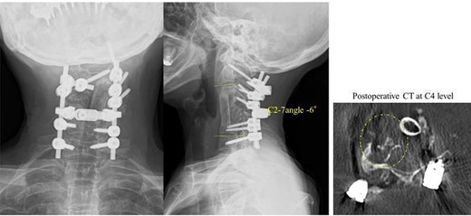 Radiography image after the three-stage combined surgery; cervical alignment was improved after this approach (the C2–7 angle was corrected from −65° to −6°).
