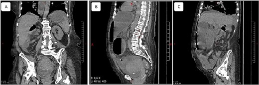 Multiple planes of computed tomography depicting the herniated cecum within the lesser sac. Reconstructed images: (A) axial, (B) and (C) sagittal views.