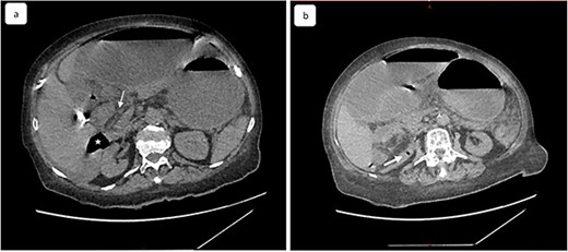 (a) Coronal view of computed tomography of abdomen and pelvis shows the dilated cecal pole and the stomach displaced anteriorly. Peritoneal fluid and some air bubbles related to intestinal perforation were observed in the lesser sac can also be observed (arrow head). (b) Closed-loop small bowel obstruction. CT scan shows a radial array of distented small bowel loops (asterisk) with stretched and thickened mesenteric vessels converging to a central point and anterior to inferior vena cava, which is compressed (white arrow).
