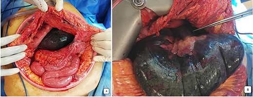 Peroperative images: (A) the distended and necrotic cecum after the opening of omental bursa by coloepiploicdetachement. (B) Ischemic herniated colon beside stretched loops and mesenteric vessels directed to the foramen of Winslow.