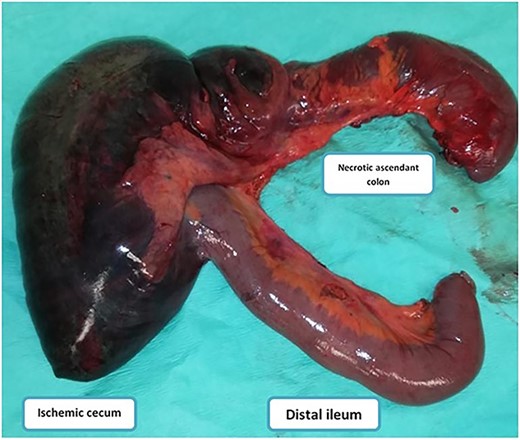 Image showing the incarcerated ileum and coecum after large surgical resection.
