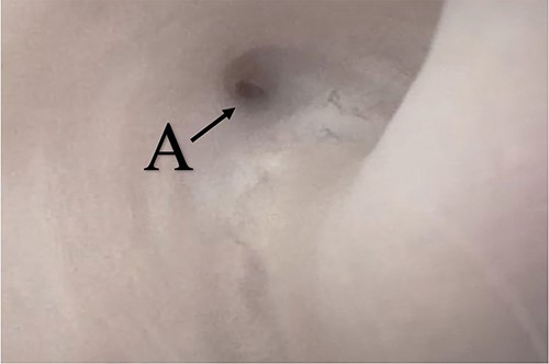 (lumen A): A pinpoint opening in the dorsal area of the urethra as pointed in the arrow.