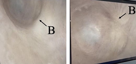 (lumen B): A blind-ended urethra in the ventral area of the urethra as pointed in the arrow.