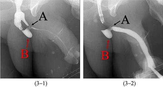 Antegrade (3–1) and retrograde (3–2) urethrogram showing the contrast passing through the pinpoint hole in the dorsal side of the urethra as pointed in black arrow, lumen A; antegrade (3–1) and retrograde (3–2) urethrogram showing a blind ended urethra in the ventral side of the urethra as pointed in red arrow, lumen B.