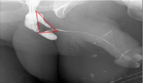 Antegrade urethrogram with the resected area marked in red line.