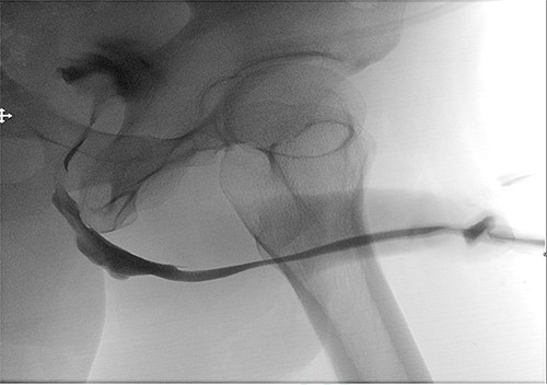 Postoperative retrograde urethrogram revealing no leakage, and a patent urethra with a wide anastomotic site at the bulbar urethra.