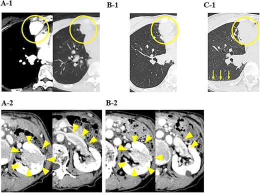 CT images of the chest and abdomen; (A) at the start of the administration of nivolumab and ipilimumab, CT showed multiple masses in both lung fields and a mass in the left kidney with a tumor plug in the left renal vein, and (B) 5 months after the administration of nivolumab and ipilimumab, CT showed increases in the sizes of the pulmonary tumors and a decrease in the size of the renal tumor, and (C) 6 months after the administration of nivolumab and ipilimumab, CT showed increases in the sizes of the pulmonary tumors and pleural effusion (yellow arrows).
