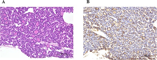A pathological examination of the pulmonary mass; (A) tumor cells formed a papillary structure, and the lumen was filled with colloids (H. E. stain), and (B) immunohistochemistry results were positive for Tg.