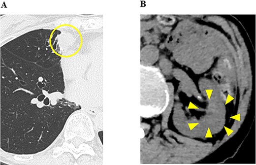 CT images of the chest and abdomen 10 months after the start of the administration of lenvatinib, and (A) pulmonary metastases decreased in size; (B) the size of the renal tumor decreased and the tumor plug disappeared.