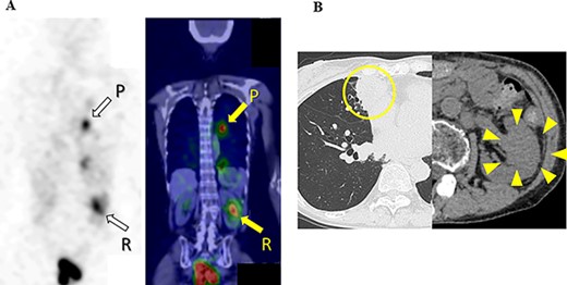 131I scintigraphy and CT images of the chest and abdomen after the second surgery; (A) in 131I scintigraphy, some lung metastases showed radioiodine uptake, whereas others did not. Radioiodine uptake was also observed in the left renal tumor, but not in the right kidney; left: RAI scintigraphy, right: SPECT–CT, P: pulmonary metastases, R: renal metastasis; (B) pulmonary and renal metastases both increased in size.
