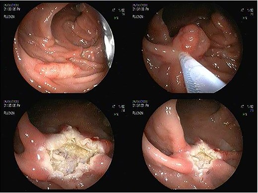 Endoscopic sessile polyp resection sequence with use of heated wire loop.