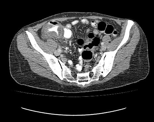 Abdominal tomography without pneumoperitoneum and with thickening of the concentric intestinal wall, without signs of intestinal perforation.
