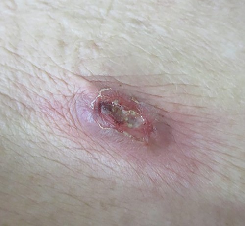A palpable tumor below the scar of appendectomy was appreciated during the first physical examination, and this eventually caused redness of the skin, which was accompanied by yellowish pus.