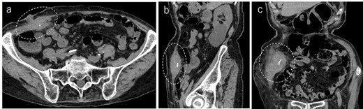 Abdominal CT demonstrated a tumor in the abdominal wall, which extended to the surface of the body (a, encircled); the tumor was 60 mm in width and contained a linear shaped agent; sagittal (b, encircled) and coronal (c, encircled) views.