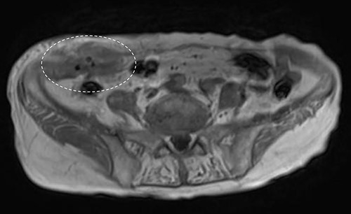 Abdominal MRI showed a low-signal nodule on T1-weighted image (encircled).