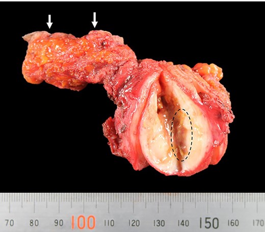 Picture of the resected tumor, fistula and skin(arrow); the tumor contained a stiff and wiry body (encircled).