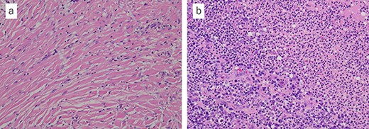 Microscopic findings with hematoxylin and eosin staining of the tumor: (a) fibrous connective tissue with diffuse infiltration of neutrophils and histiocytes; (b) the tissue contained abscess and bacteria (a ×20, b ×20).
